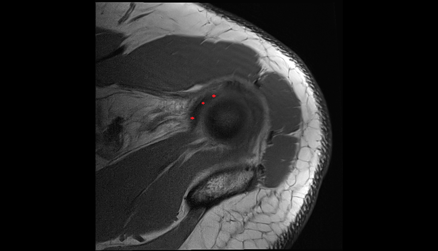 glenohumeral ligaments axial cross sectional anatomy 3T MRI AI enhanced radiology image-img-00000-00000