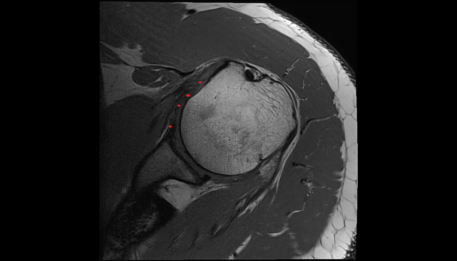 glenohumeral ligaments axial cross sectional anatomy 3T MRI AI enhanced radiology image-img-00000-00000_00001