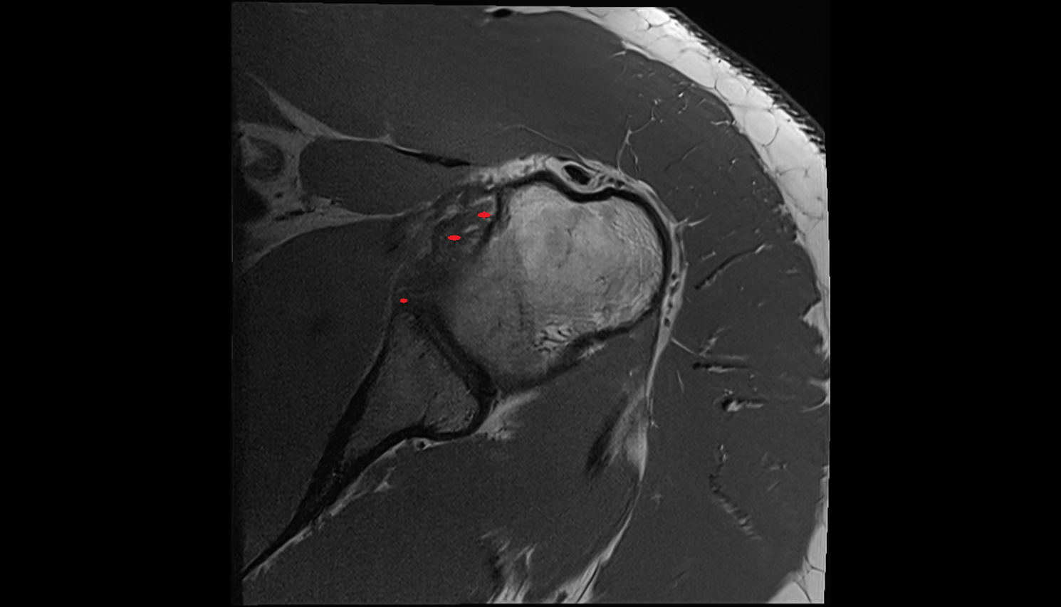 glenohumeral ligaments axial cross sectional anatomy 3T MRI AI enhanced radiology image-img-00000-00000_00002