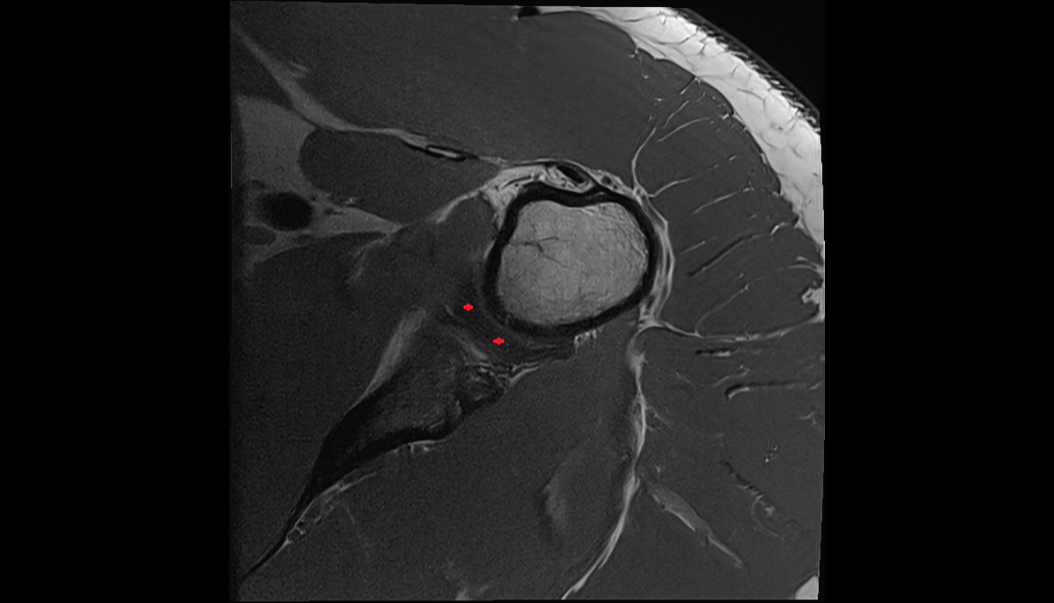 glenohumeral ligaments axial cross sectional anatomy 3T MRI AI enhanced radiology image-img-00000-00000_00003