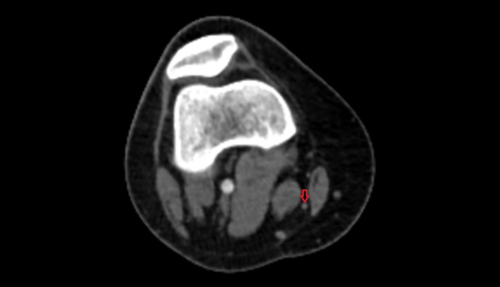 gracilis tendon ct axial image