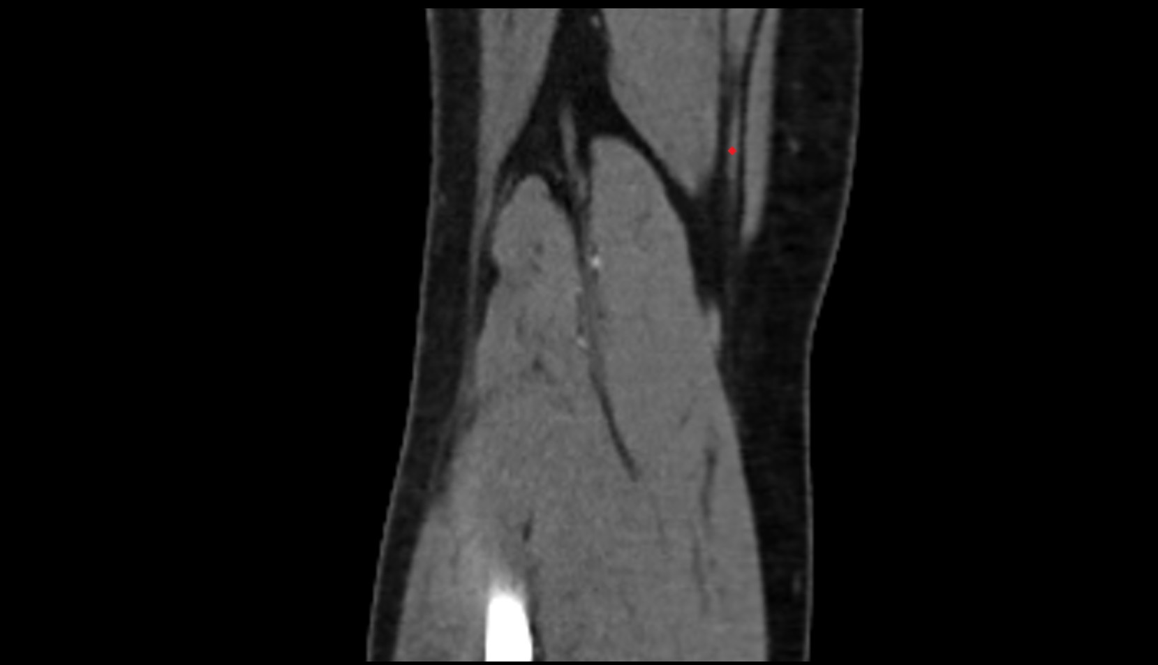 gracilis tendon ct sagittal image coronal ct