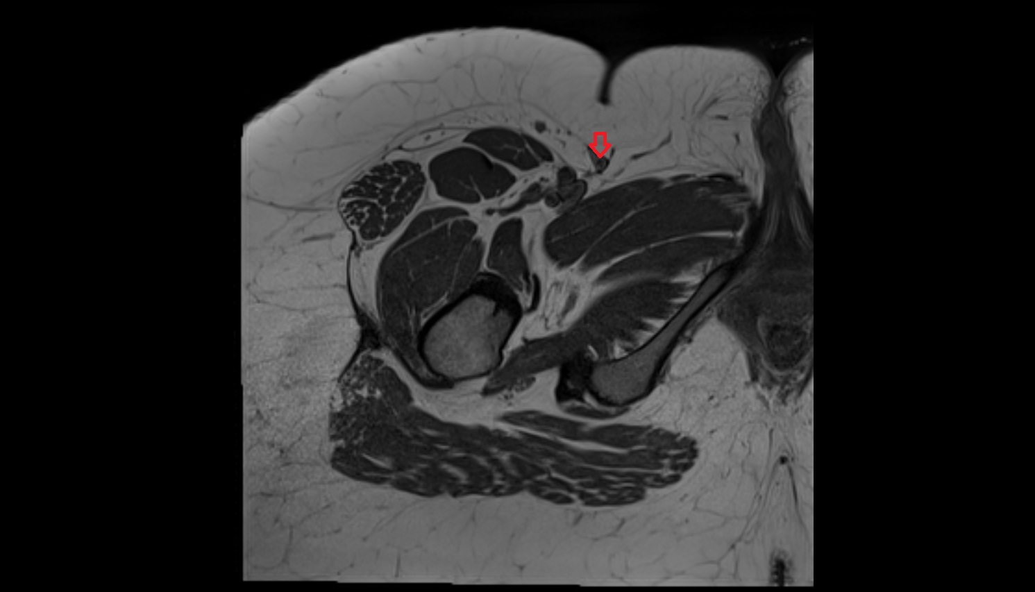 great saphenous vein MRI  axial  anatomy  image-img-00000-00000