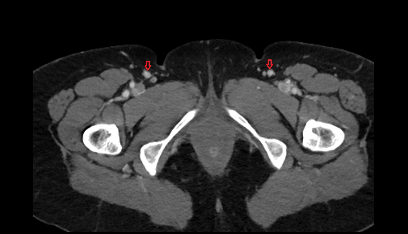 great saphenous vein ct axial image