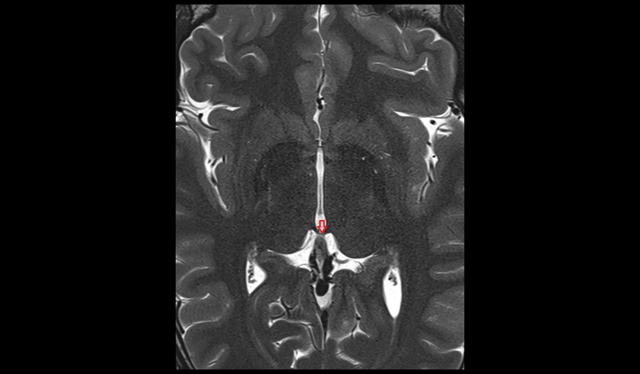 habenular commissure mri 3t axial image