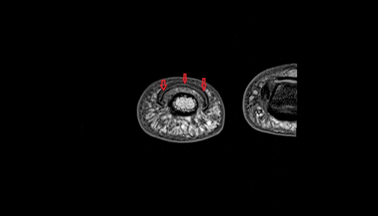 hand nail  MRI axial  image-img-00000-00000