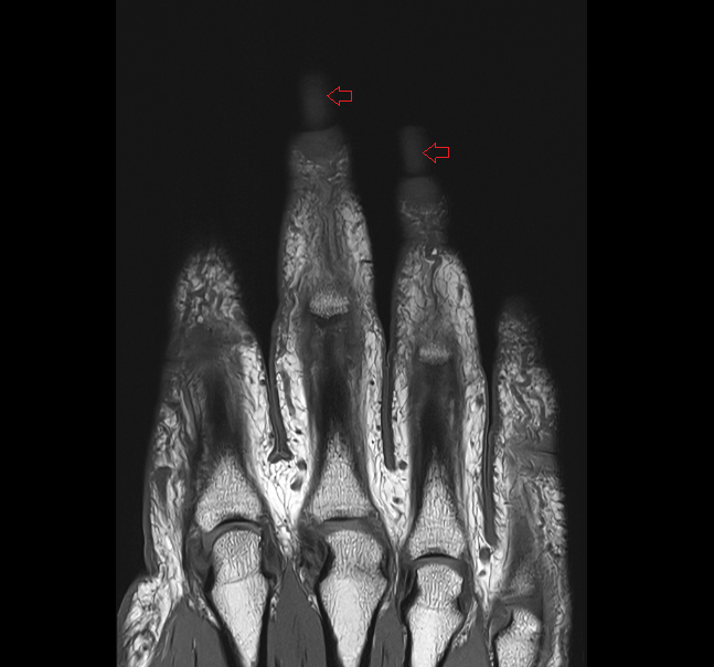hand nail  MRIcoronal  image-img-00000-00000