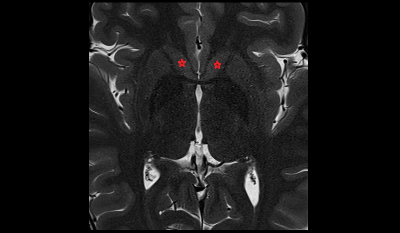 head of caudate nucleus mri 3t axial image