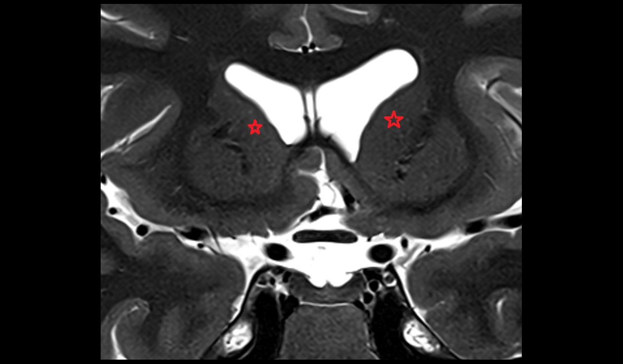 head of caudate nucleus mri 3t coronal image