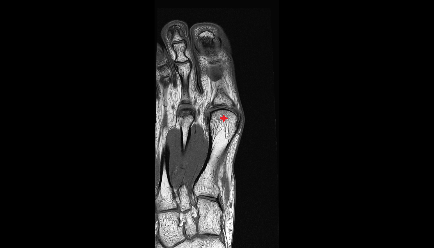 head of metatarsal bone  coronal cross sectional anatomy 3T MRI AI enhanced radiology image-img-00000-00000