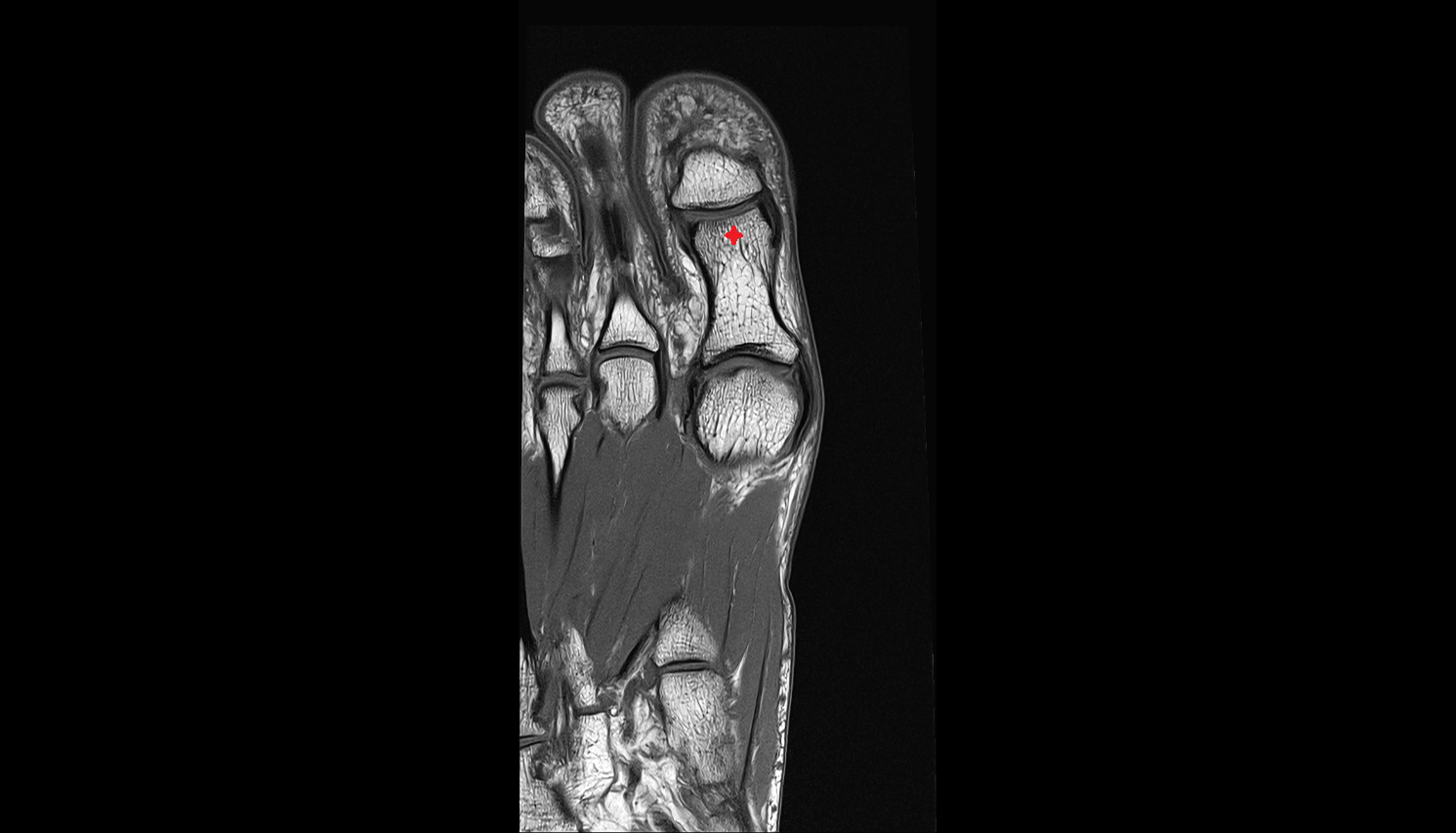 head of phalanx of foot coronal cross sectional anatomy 3T MRI AI enhanced radiology image-img-00000-00000