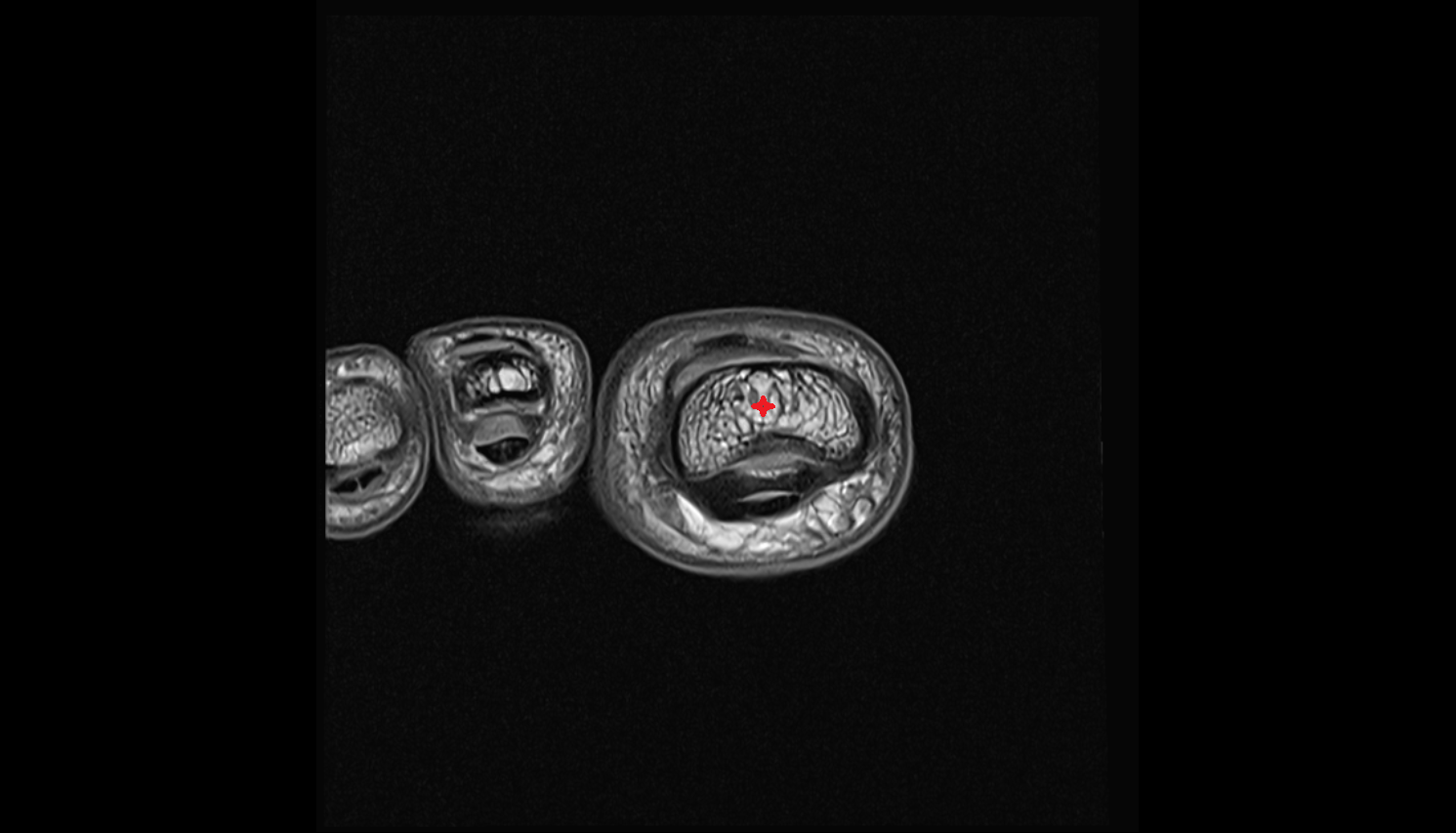 head of phalanx of foot coronal cross sectional anatomy 3T MRI AI enhanced radiology image-img-00000-00000_00001
