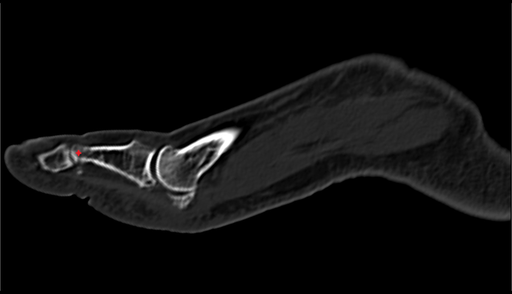 head of phalanx of foot ct sag image