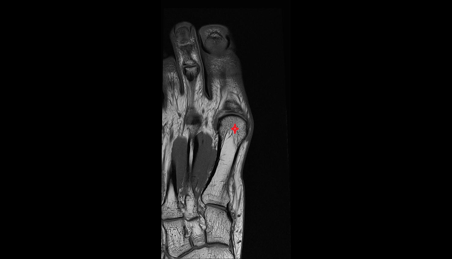 head of the metatarsal bone  coronal cross sectional anatomy 3T MRI AI enhanced radiology image-img-00000-00000