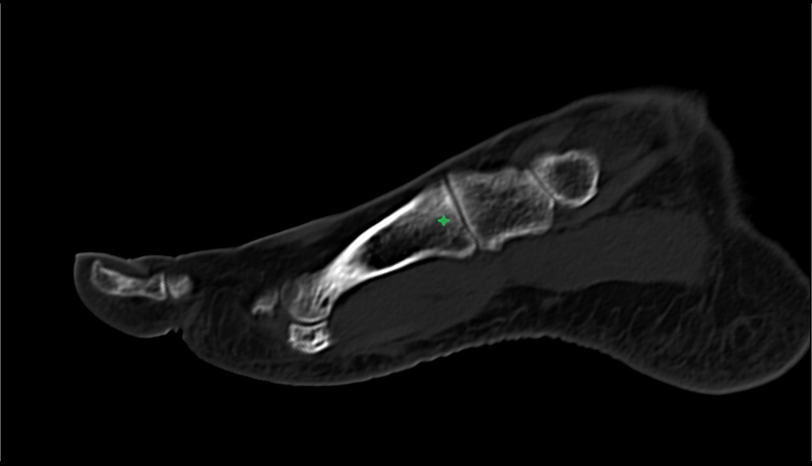 head of the metatarsal bone ct sag image