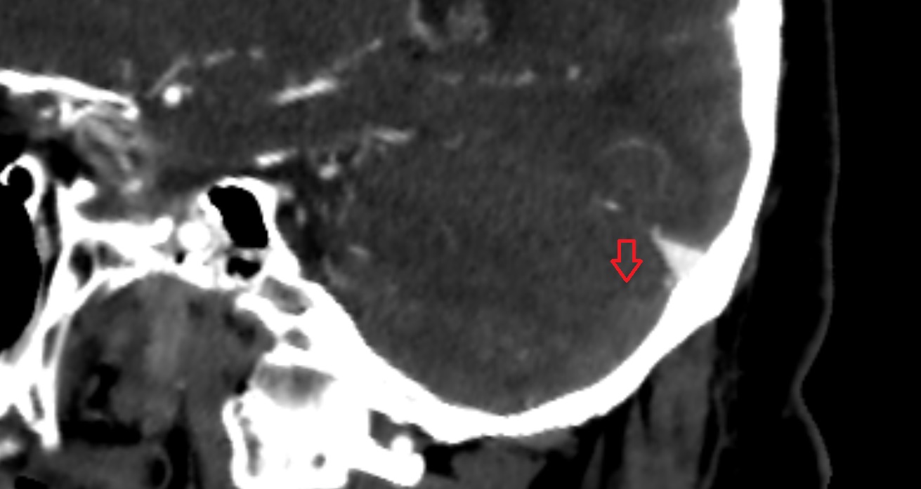 horizontal fissure of cerebellum  CT sag  anatomy image -img-00001-00001