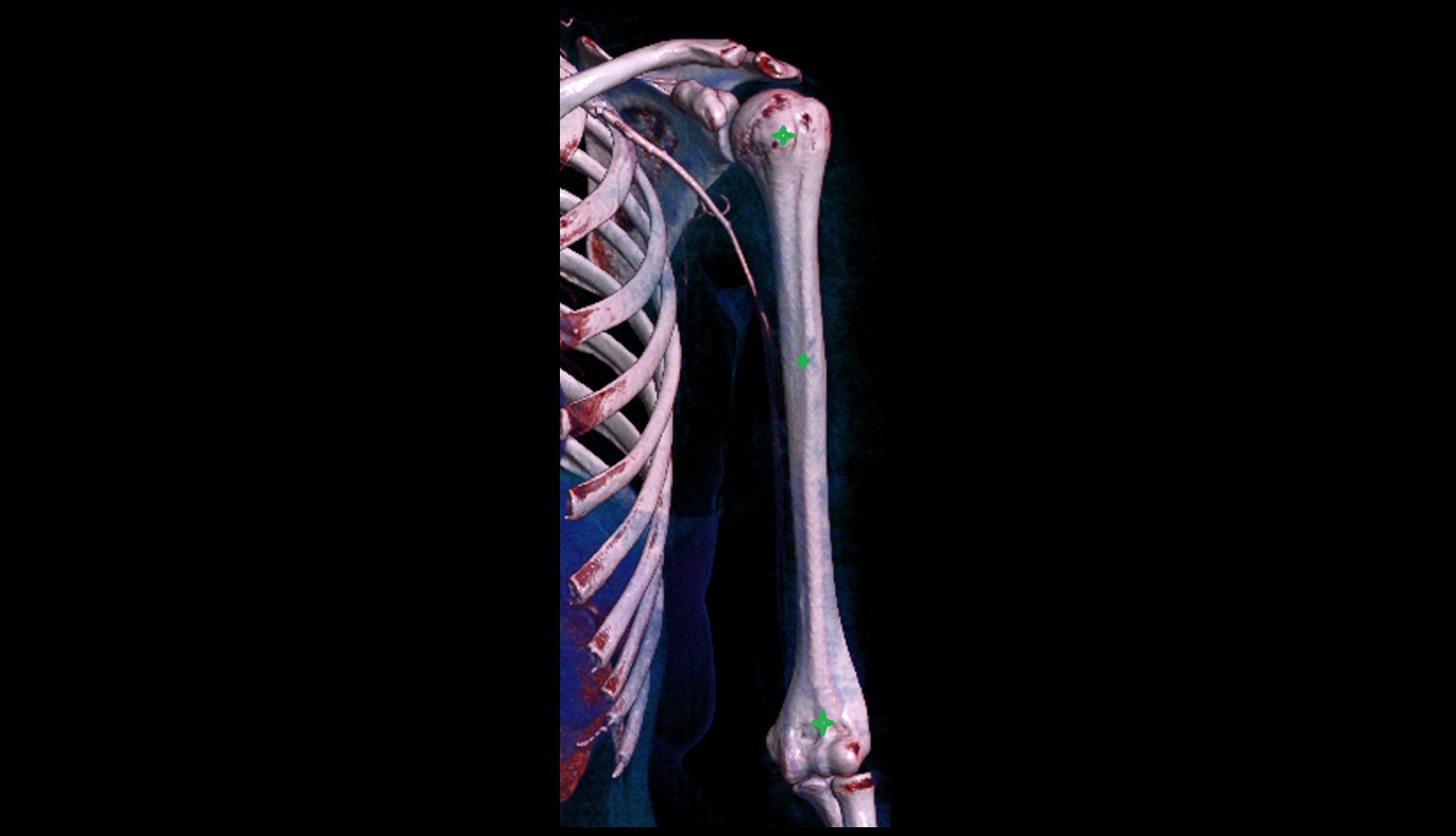 humerus bone 3D VRT IMAGE