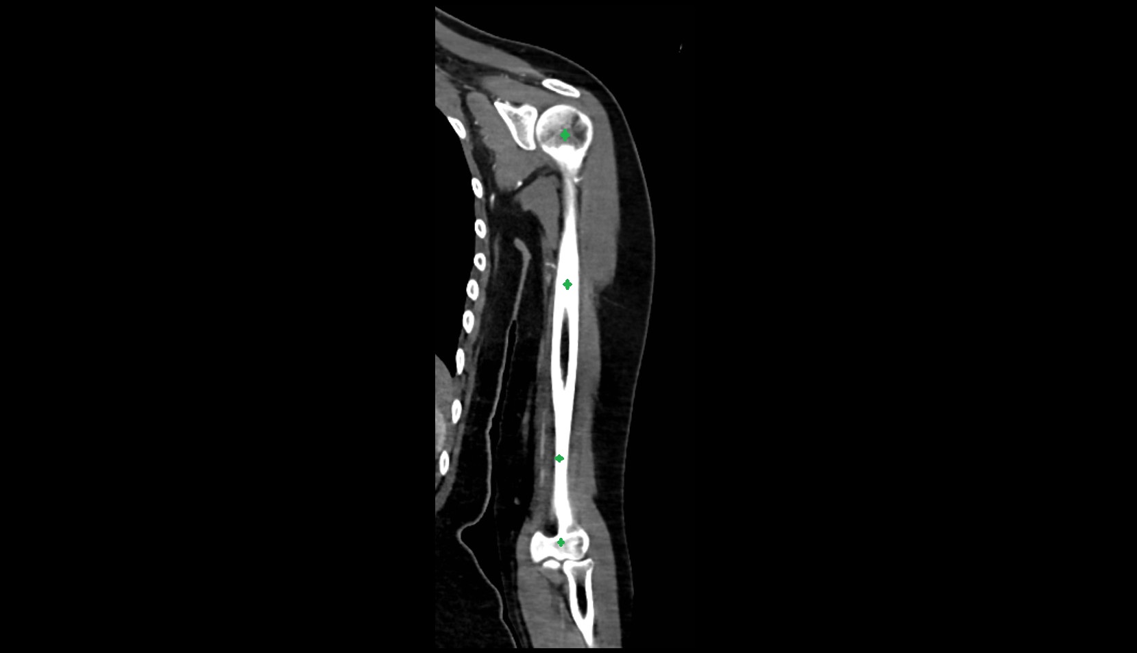 humerus bone CT CORONAL IMAGE