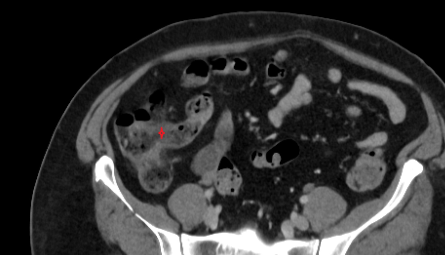 Ileocaecal valve CT axial  anatomy  image -img-00000-00000