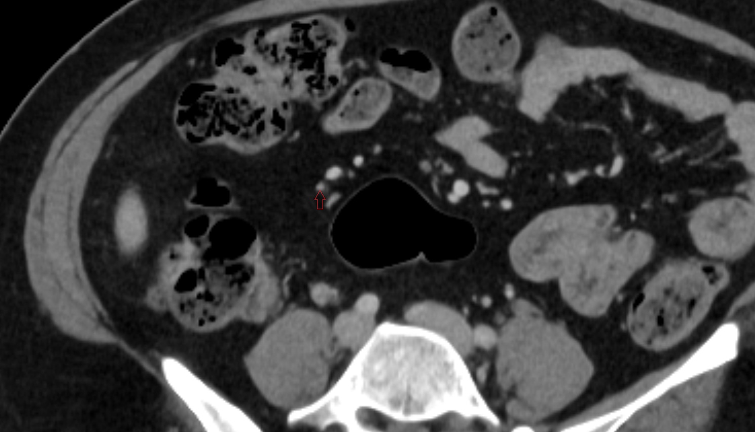 ileocolic artery colic branches  CT axial anatomy  image -img-00000-00000