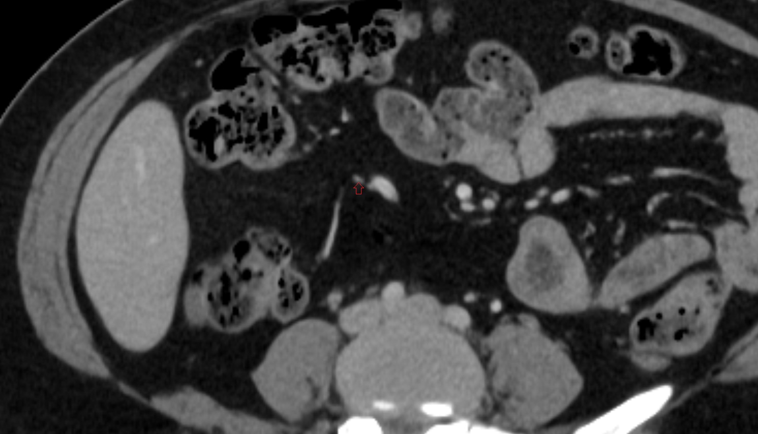 ileocolic artery colic branches  CT axial anatomy  image -img-00000-00000_00001