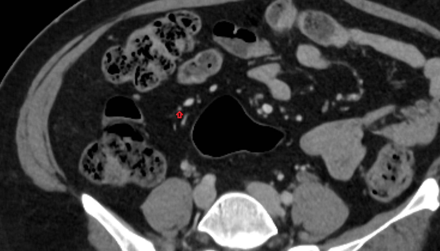 ileocolic artery colic branches  CT axial anatomy  image -img-00000-00000_00002