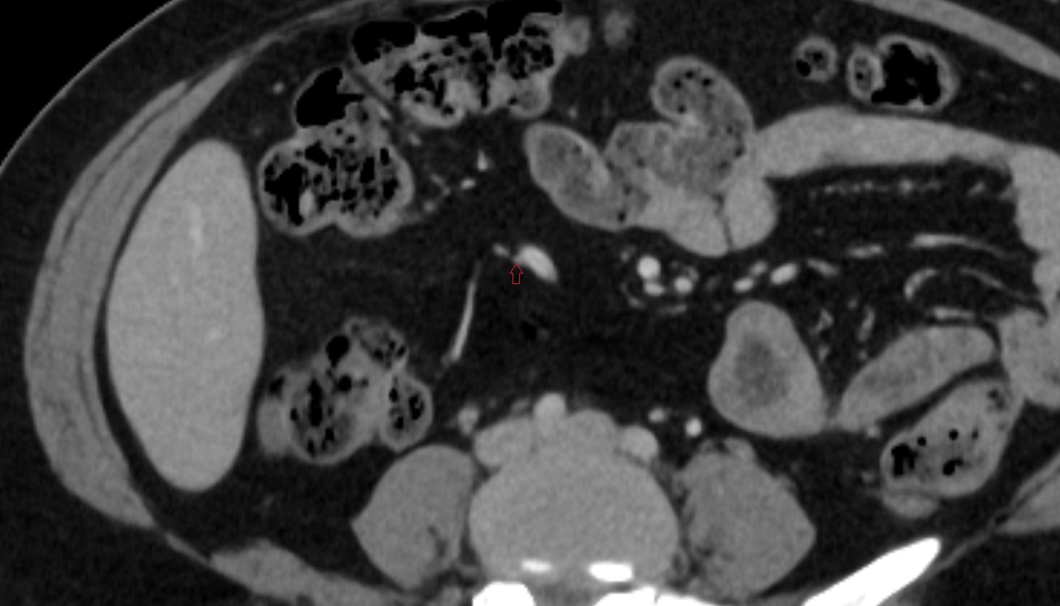 ileocolic artery ileal branches  CT axial anatomy  image -img-00000-00000