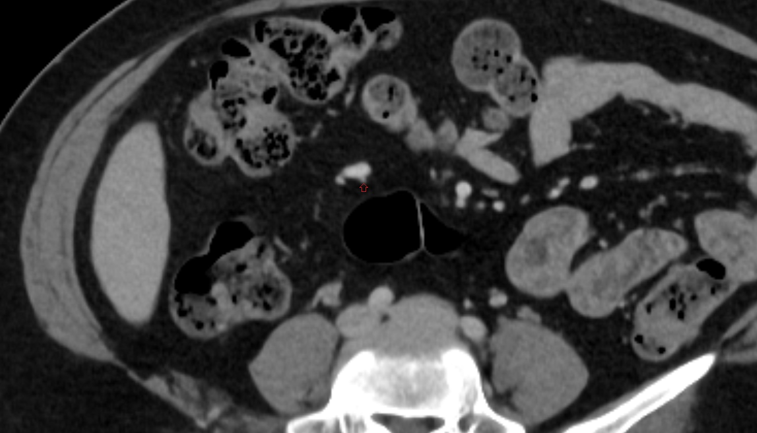 ileocolic artery ileal branches  CT axial anatomy  image -img-00000-00000_00001