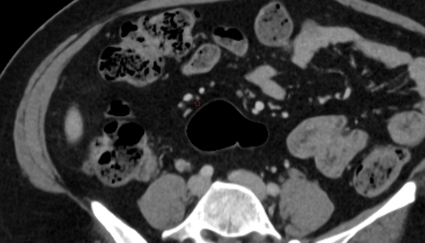 ileocolic artery ileal branches  CT axial anatomy  image -img-00000-00000_00002
