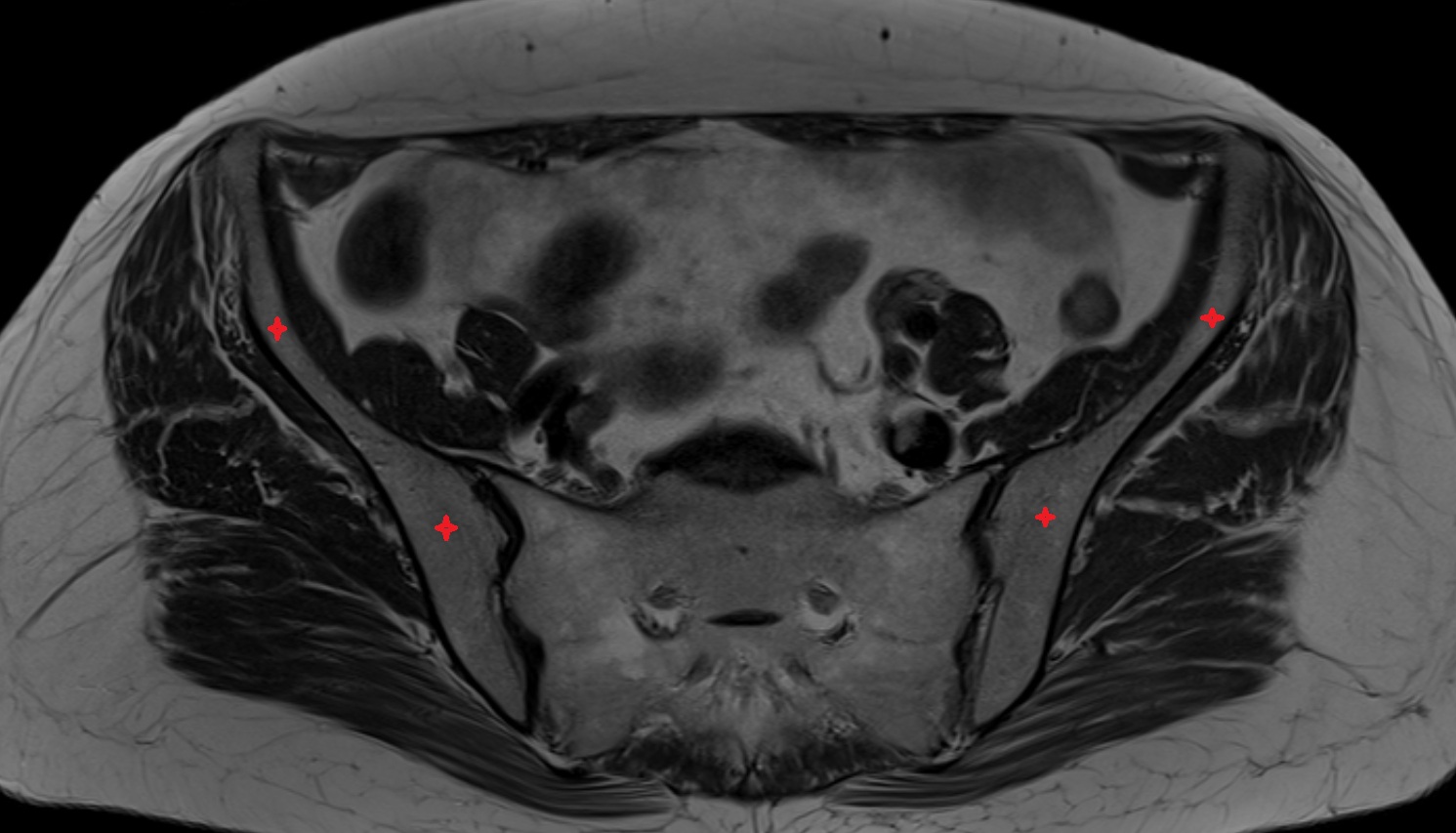 ilium bone  MRI  axial  anatomy  image-img-00000-00000