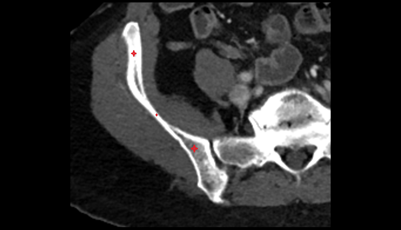 ilium bone ct axial