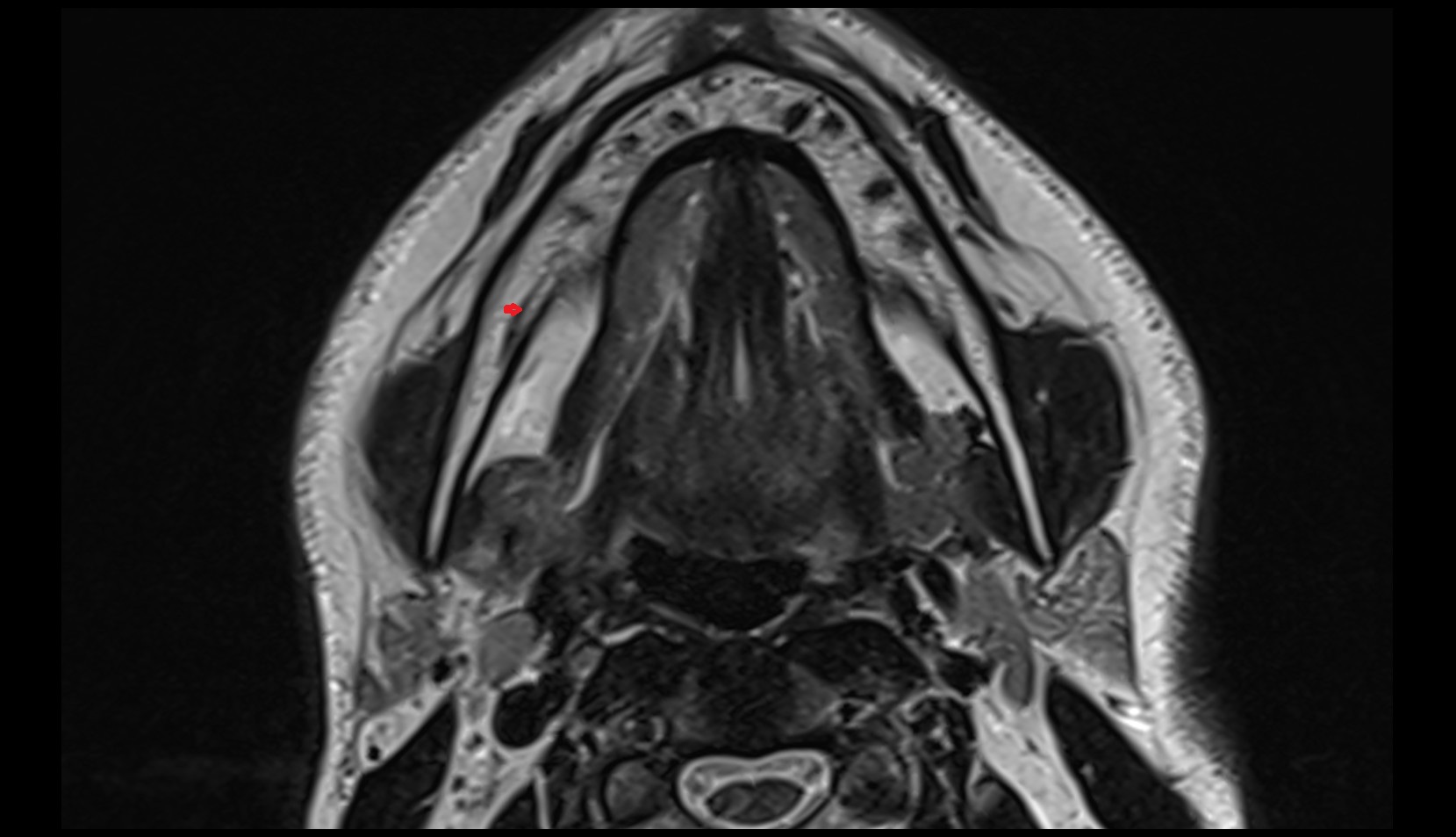 inferior alveolar artery axial mri image