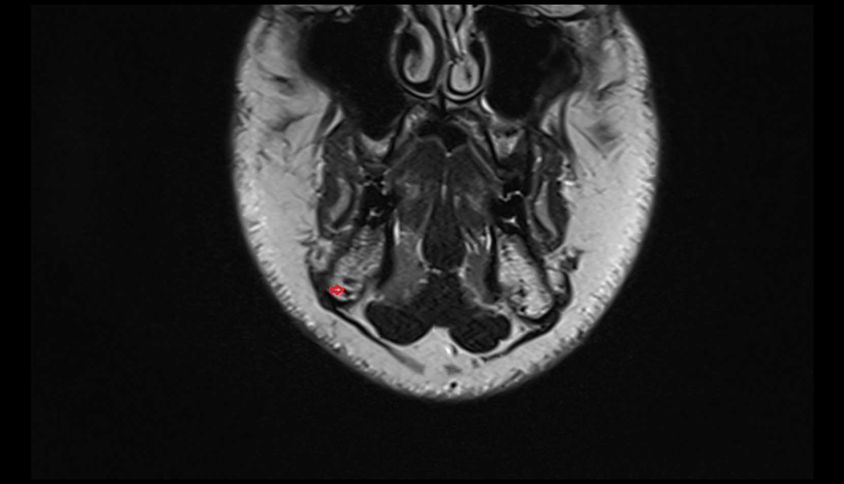 inferior alveolar artery  coronal mri image