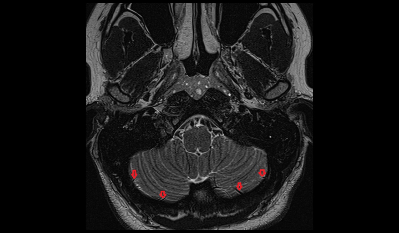 inferior hemispheric veins MRI 3T axial image