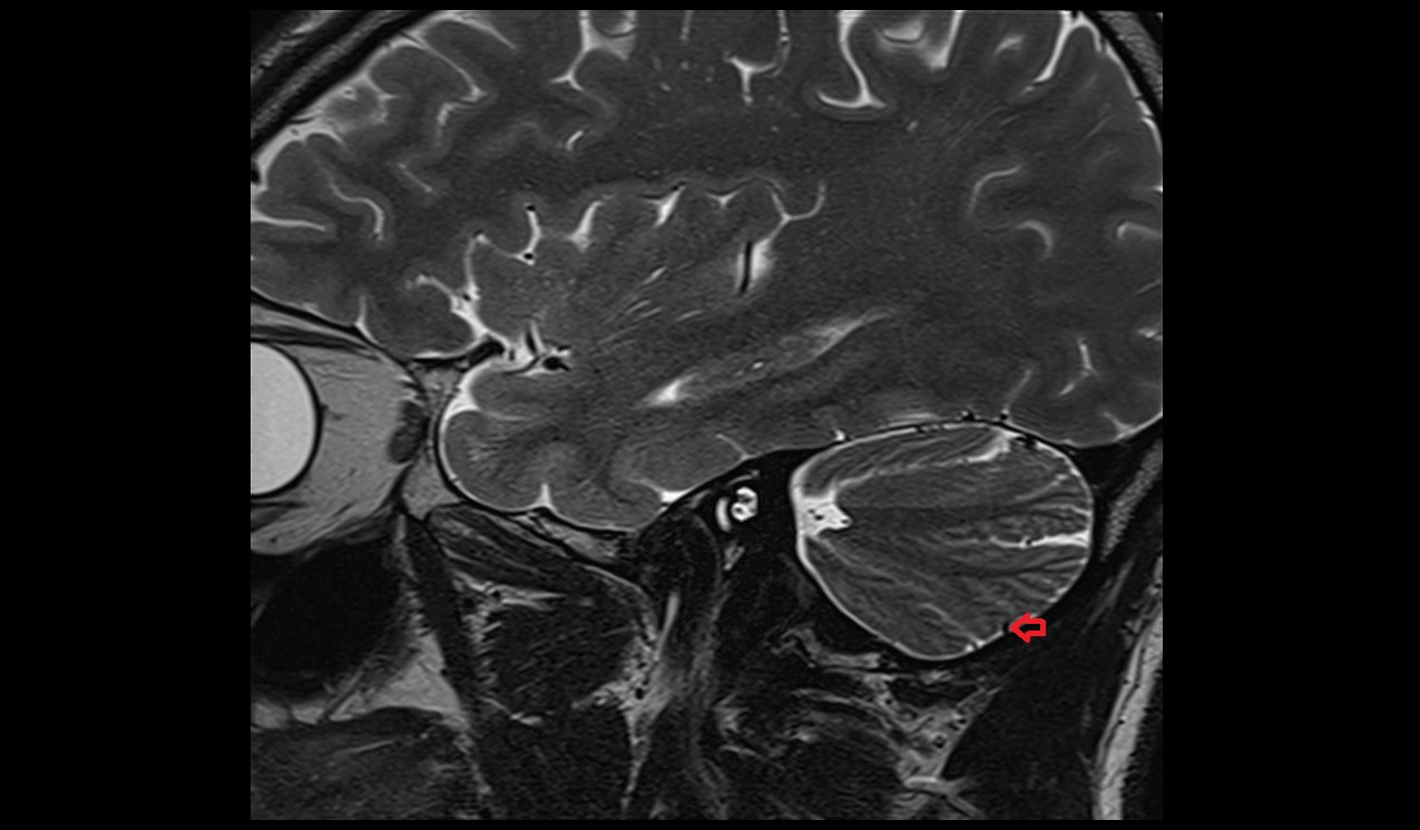 inferior hemispheric veins MRI 3T sagittal image