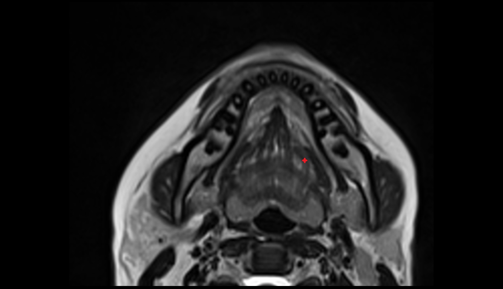 inferior longitudinal lingual muscle mri axial image