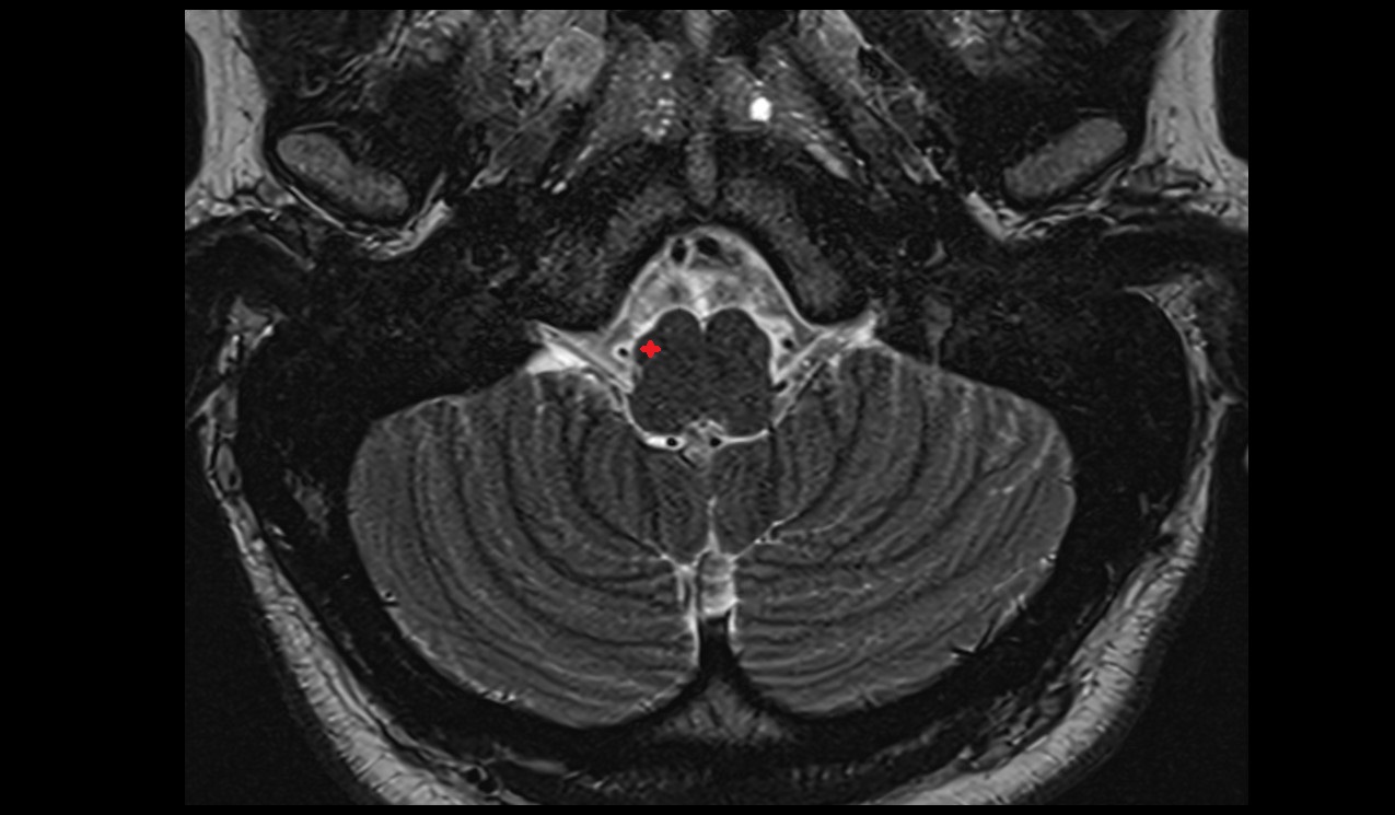 inferior olivary complex mri 3t axial image