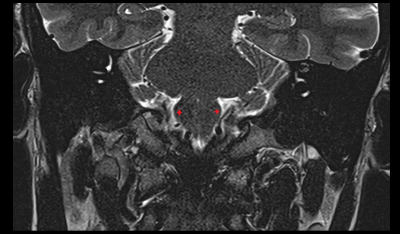 inferior olivary complex mri 3t coronal image
