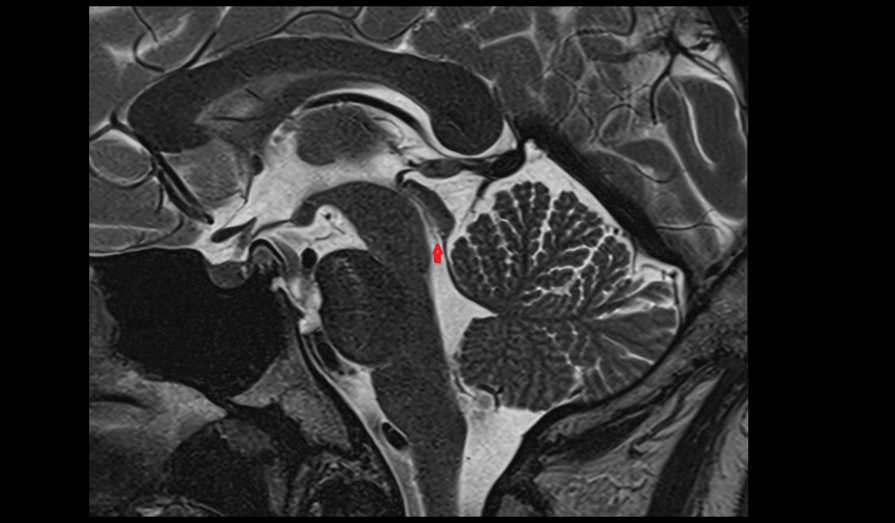 inferior opening of cerebral aqueduct mri 3t sagittal image