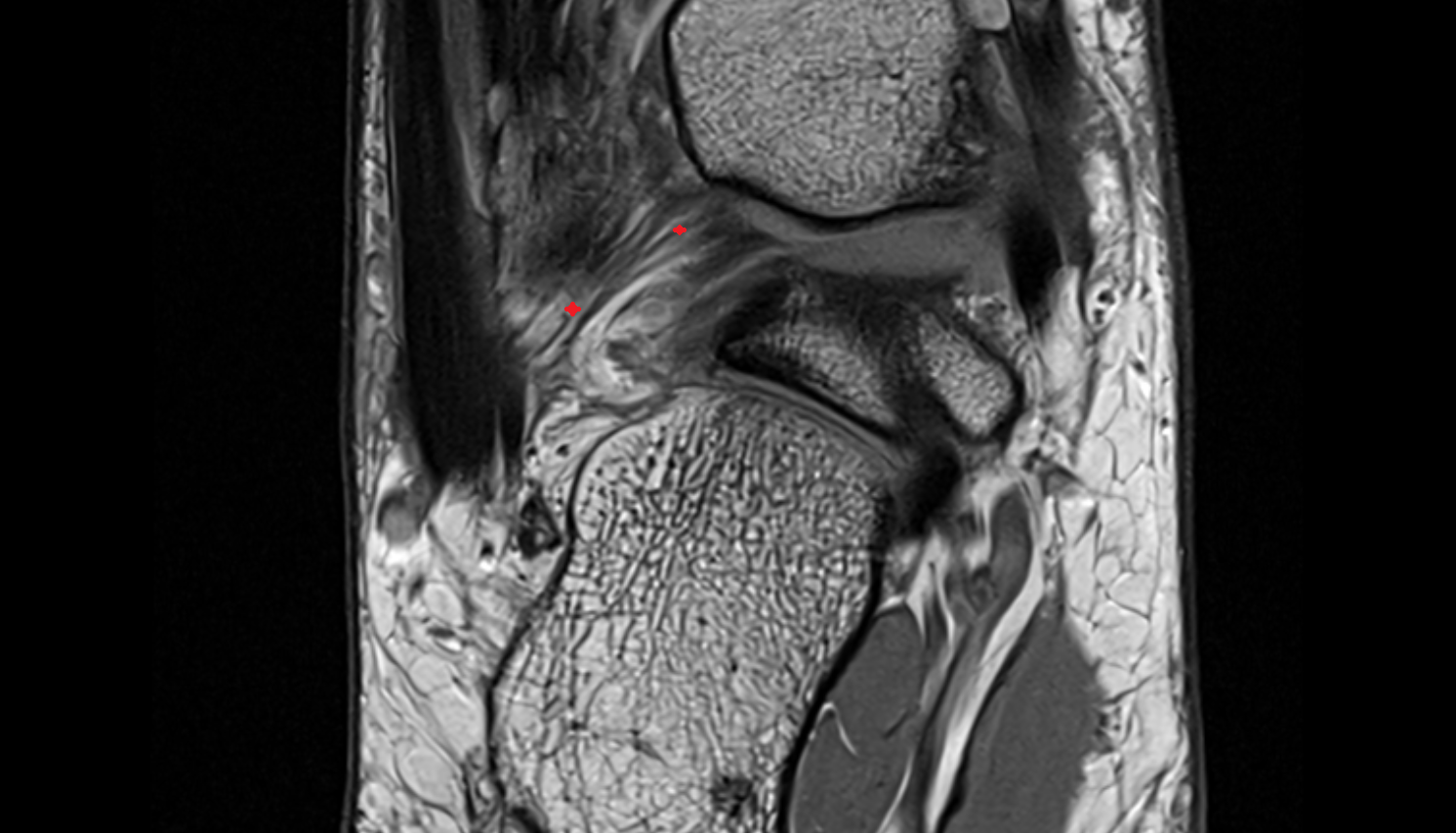 inferior transverse ligament  ankle coronal cross sectional anatomy 3T MRI AI enhanced radiology image-img-00000-00000