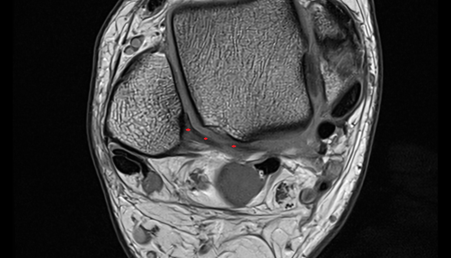 inferior transverse ligament  axial cross sectional anatomy 3T MRI AI enhanced radiology image-img-00000-00000