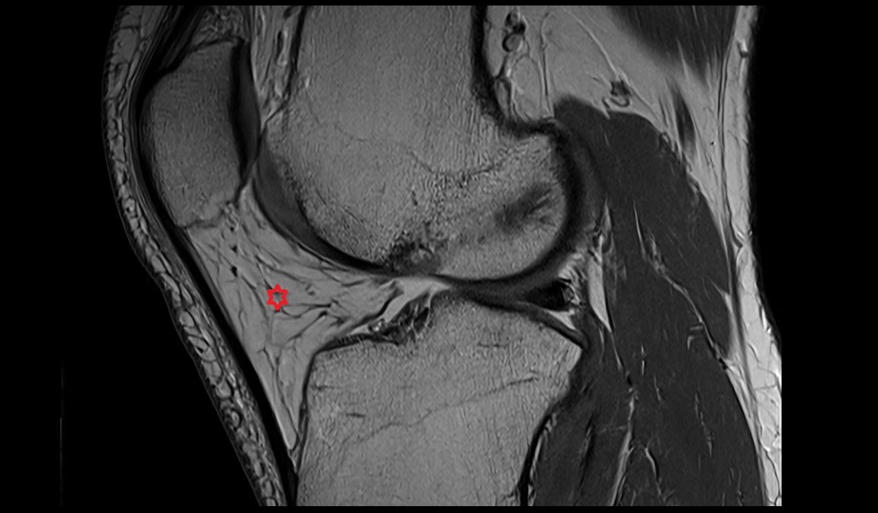 infrapatellar fat pad,(Hoffa's fat )