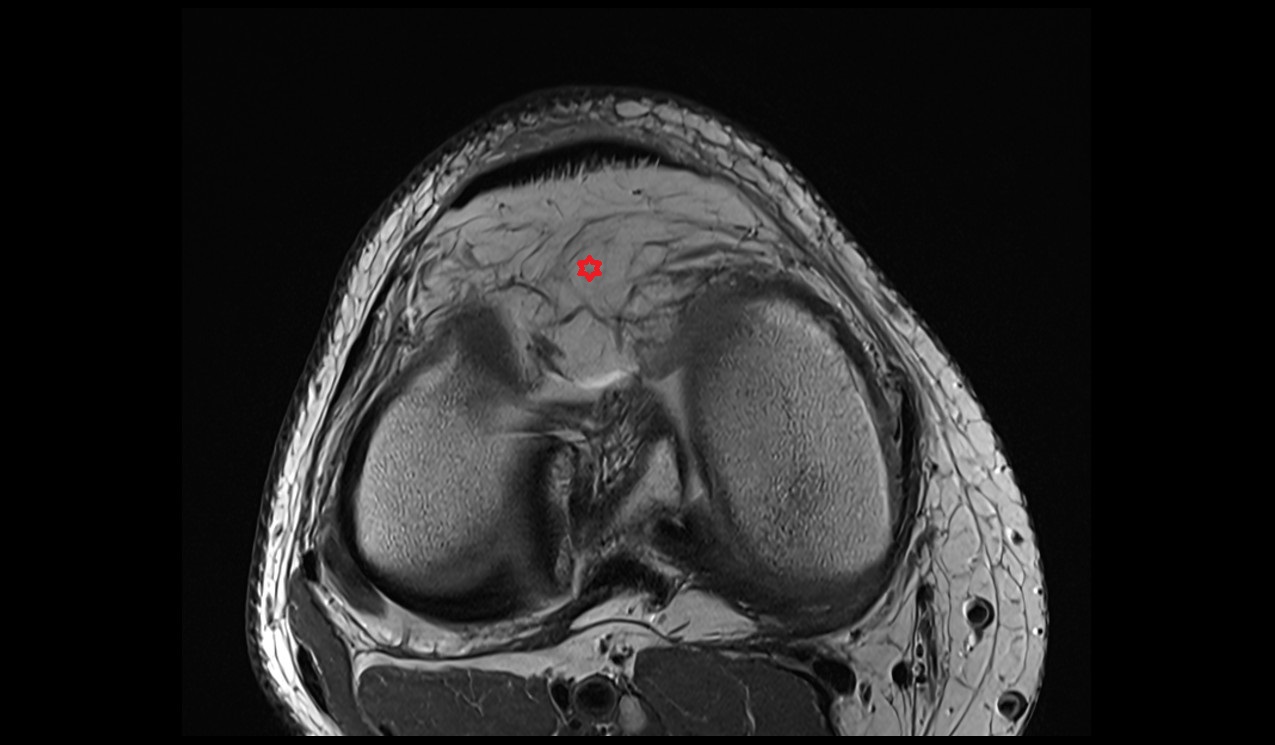 infrapatellar fat pad,(Hoffa's fat ) anatomy image