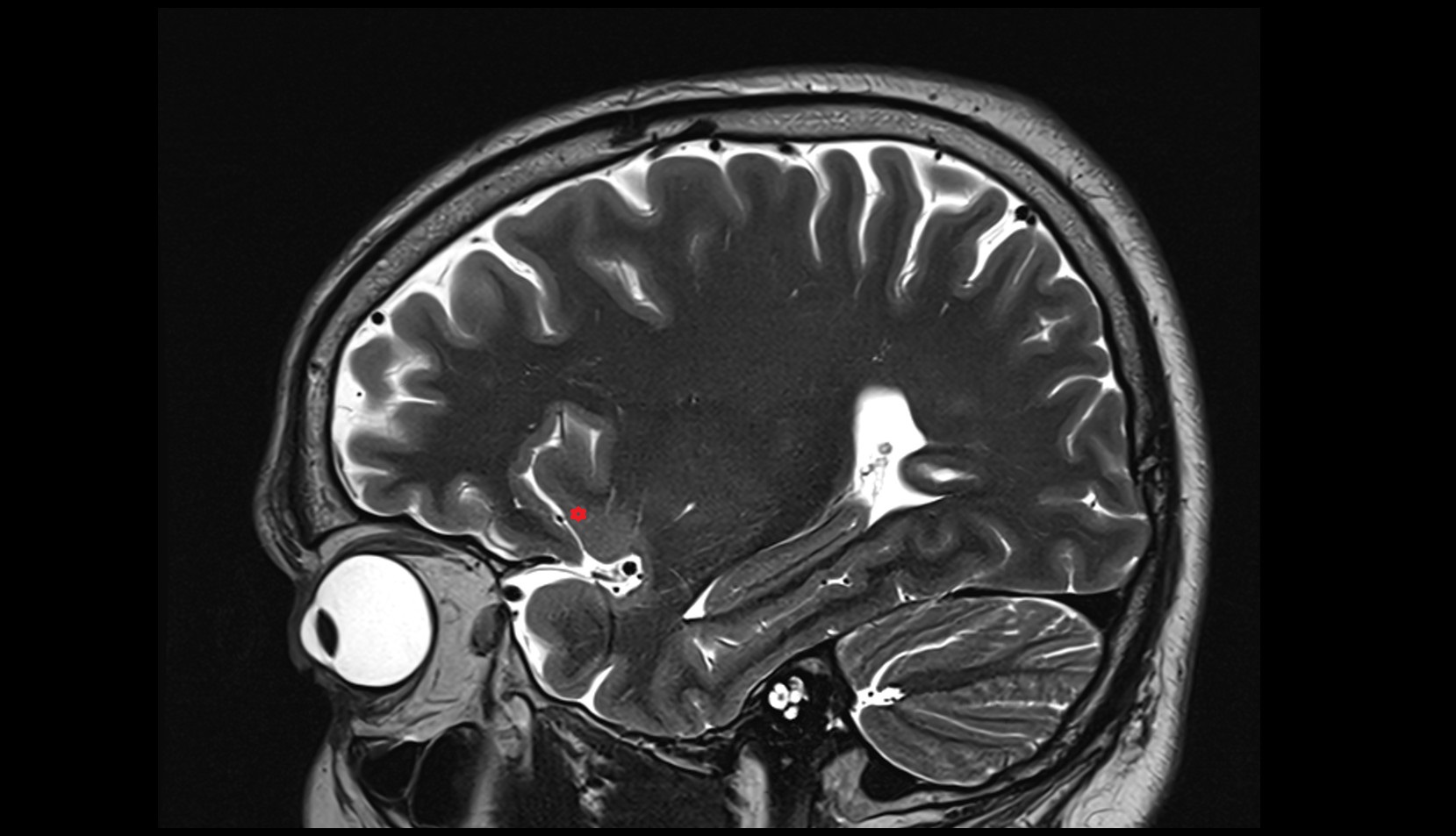insular cortex mri 3t sagital image