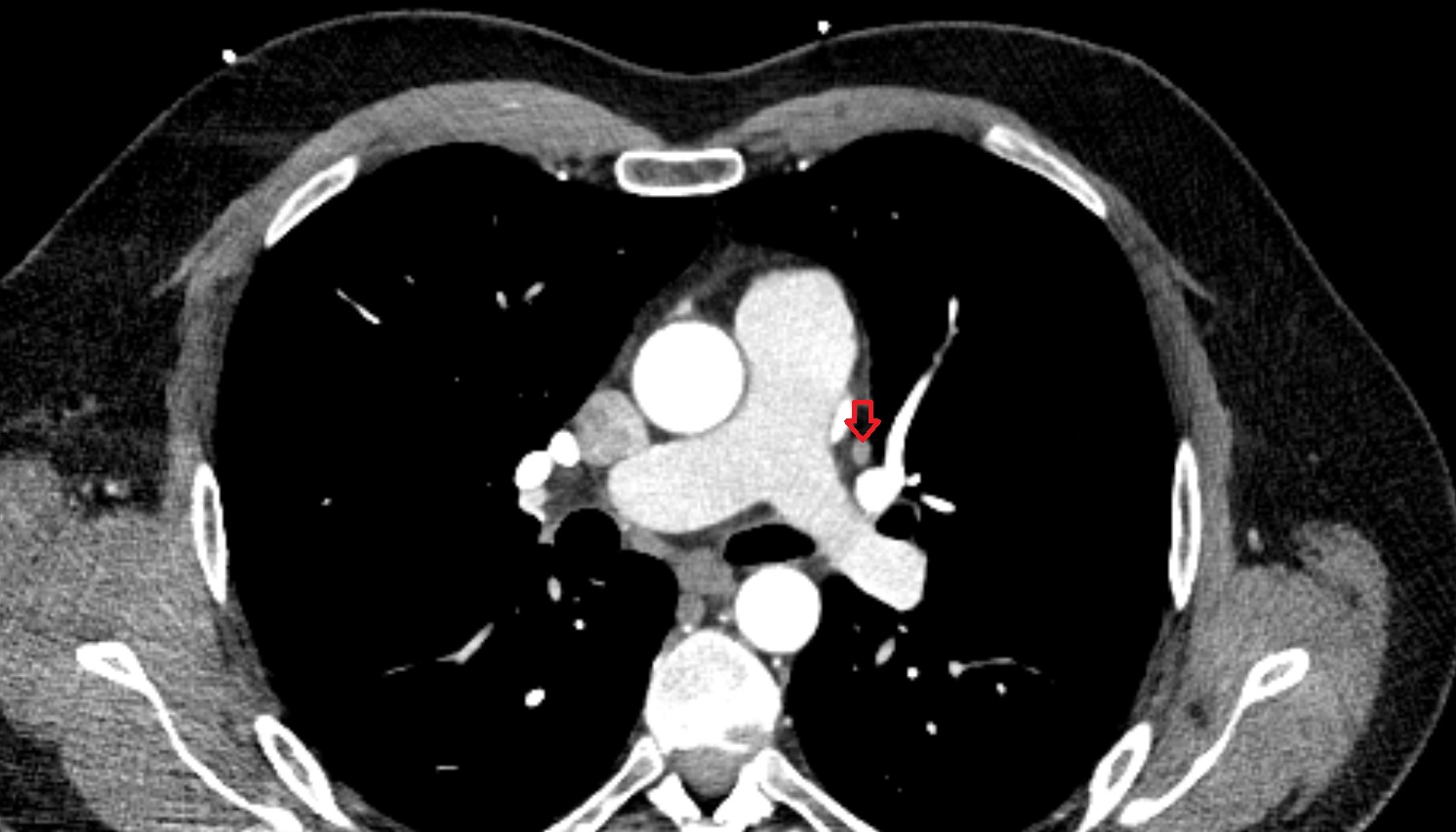 interlobar lymph nodes  anatomy CT coronal  image -img-00000-00000