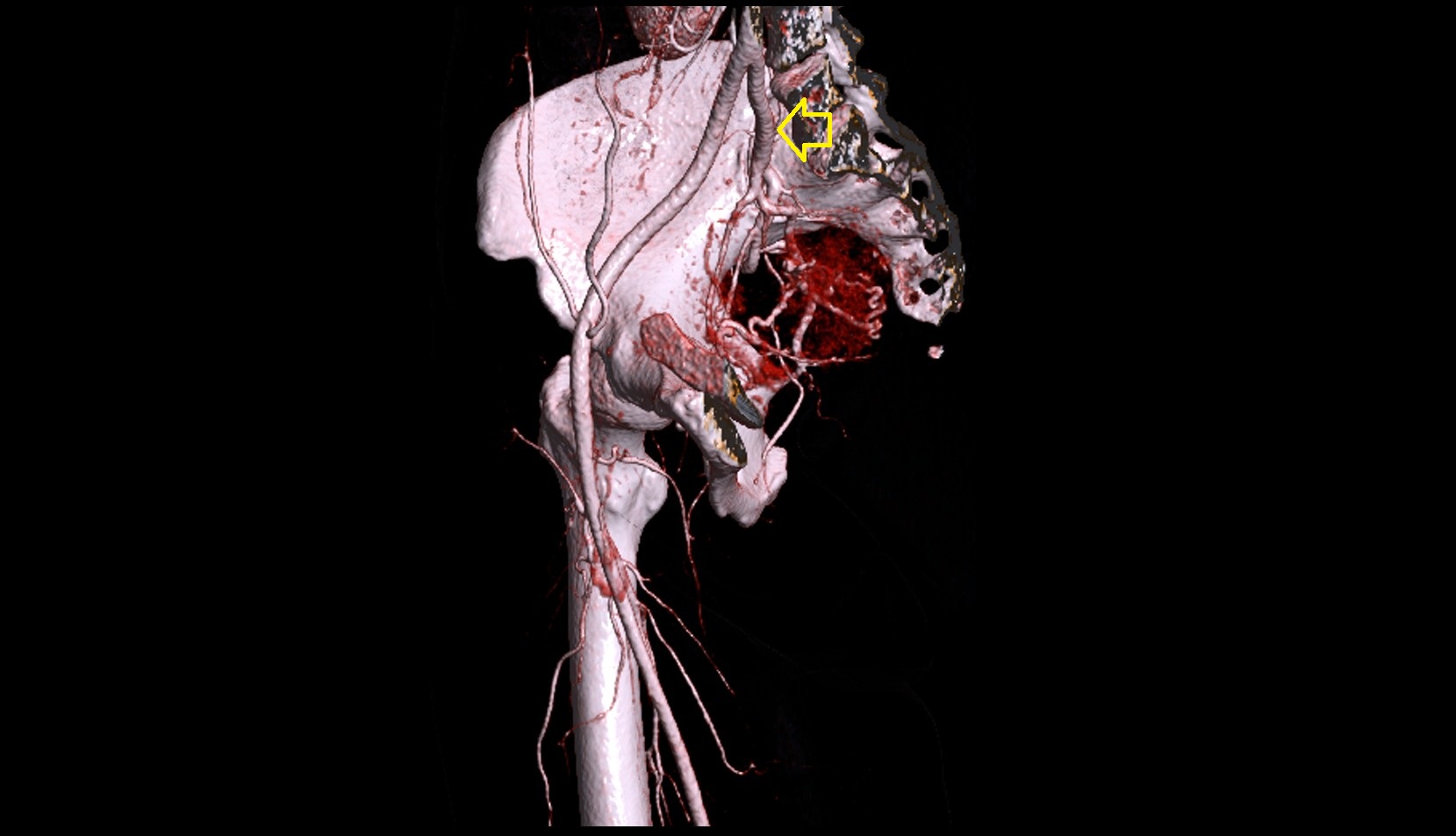 internal iliac artery  CT 3D VRT anatomy image
