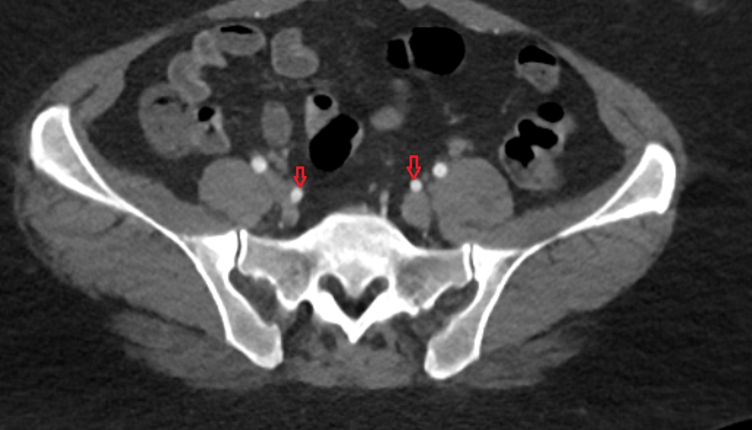 internal iliac artery  CT axial image  MRI  axial  anatomy  image-img-00000-00000