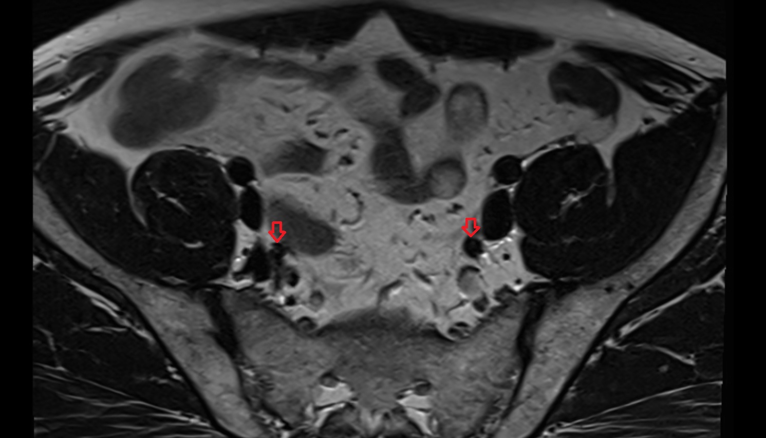 internal iliac artery  MRI axial image  MRI  axial  anatomy  image-img-00000-00000