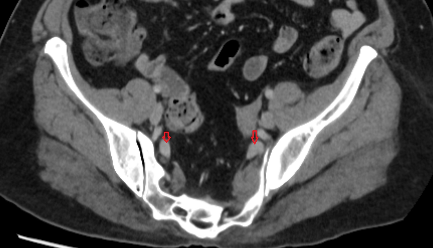 internal iliac vein  CT axial  anatomy  image-img-00000-00000