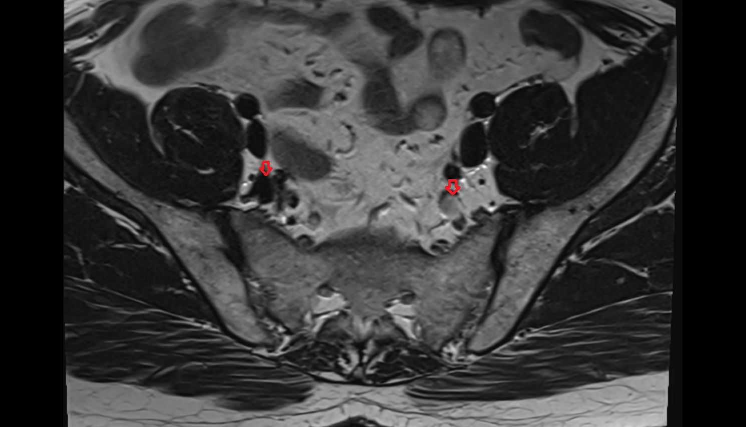 internal iliac vein MRI  axial  anatomy  image-img-00000-00000